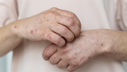   Por brote en Maule: Recomendaciones para prevenir la escarlatina 