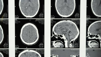   Una investigación británica vincula la menopausia con síntomas similares al Alzheimer 