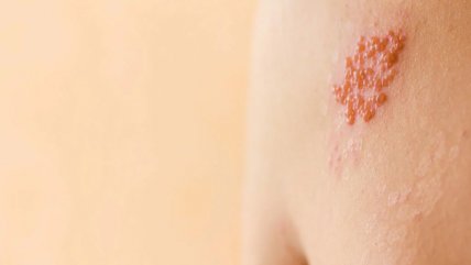   La importancia de tratar el herpes zóster, que afecta a casi todos los mayores de 50 años 