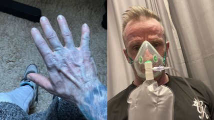   Hombre despertó completamente azul y terminó en urgencias: Motivo lo dejó en vergüenza 